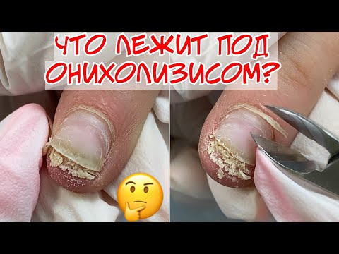 Снова Онихолизис 😱 Работа другого мастера 🤔 Почему нельзя делать протезирование онихолизиса?