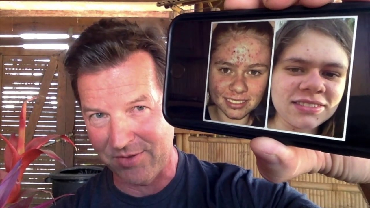 Treat demodex blepharitis with okra-based product 