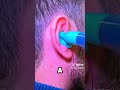 why doctors put plastic in your ears