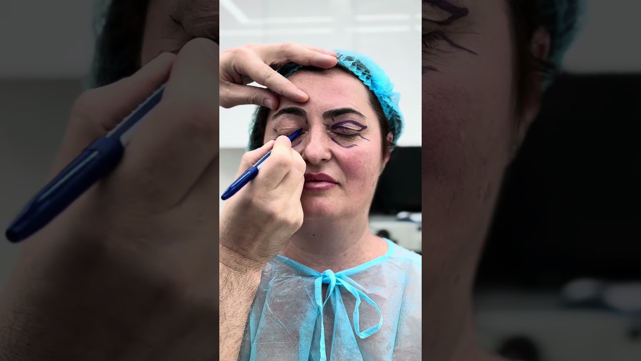 Înainte și după 7 și 14 zile de la operația de Blefaroplastie la Clinica Doctor Levy din București