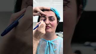 Înainte Și După 7 Și 14 Zile De La Operația De Blefaroplastie La Clinica Doctor Levy Din București
