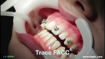 FAQFix - Direct Technique - Step 1 - Trace FACC.mp4