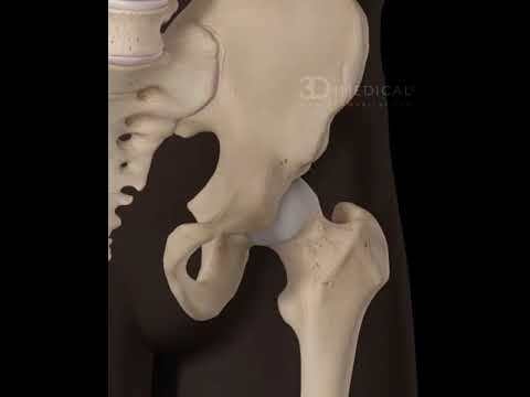 Video: ¿Pueden encogerse los huesos de la cadera?