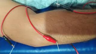 Arthritis joints pain treatment by Acupuncture needles