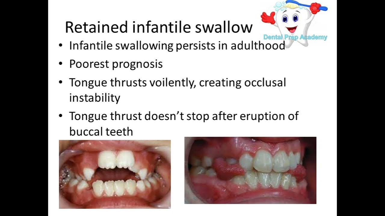 Types of Swallowing Orthodontics YouTube