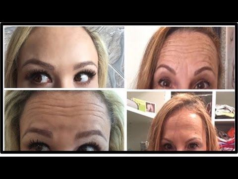 Vídeo: Mudou Muito: A Grávida Meryem Uzerli Era Suspeita De Injeções De Botox