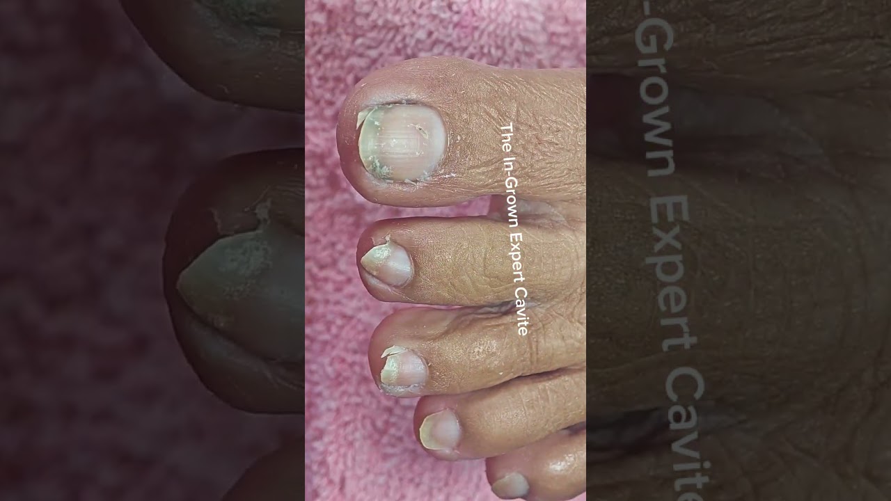 Full video pedicure with ingrown removal 