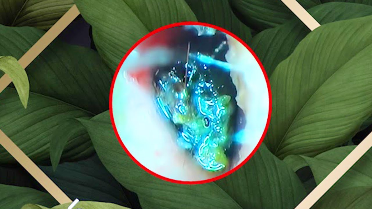 Satisfying Ear Wax Removal With Dr Zhao Video YouTube