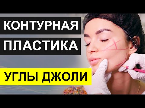 КАК ВИЗУАЛЬНО СУЗИТЬ ЛИЦО - Контурная пластика УГЛЫ ДЖОЛИ