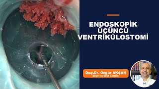 Endoskopik Üçüncü Ventrikülostomi: Minimal İnvaziv Bir Yaklaşım - Bölüm 3 - Dr. Özgür Akşan