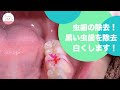 左下奥歯に黒い虫歯が!! Tooth Decay Treatment of Lower Left Teeth!!