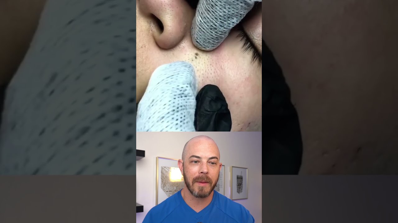 Derm Reacts To MASSIVE Pimple Dermreacts Doctorreacts Pimplepop Pores