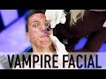 Microneedling mon propre visage comment faire un visage vampire