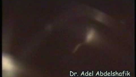 Ophthalmolgy- Test yourself: gonioscopy 03