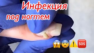 Инфекция под ногтем😱😨⚠️🆘