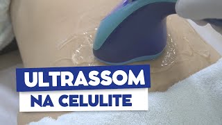 Ultrassom no tratamento da celulite | Dr João Tassinary