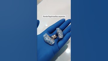 Where timing is everything! #braces #orthodontics #dentist #orthopaedics #teeth #expansion