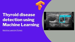 Information Thyroid disease detection using Machine Learning Update