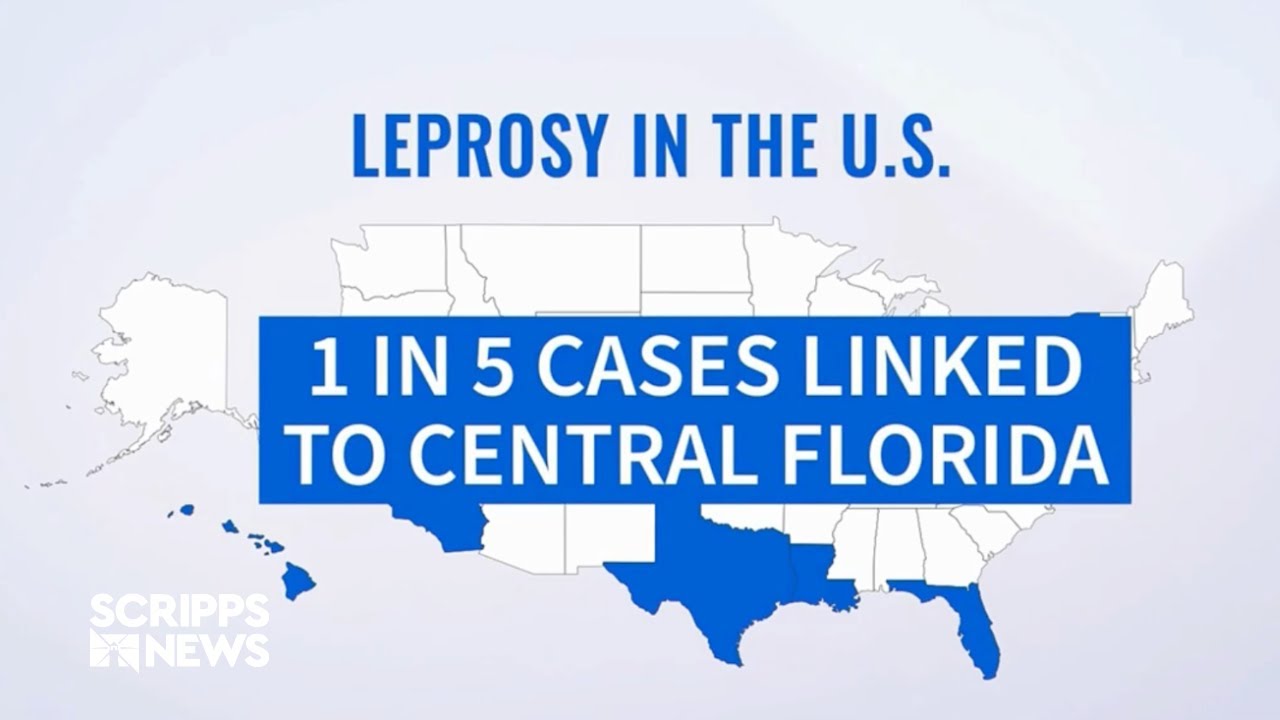 Rise in leprosy cases across the country YouTube