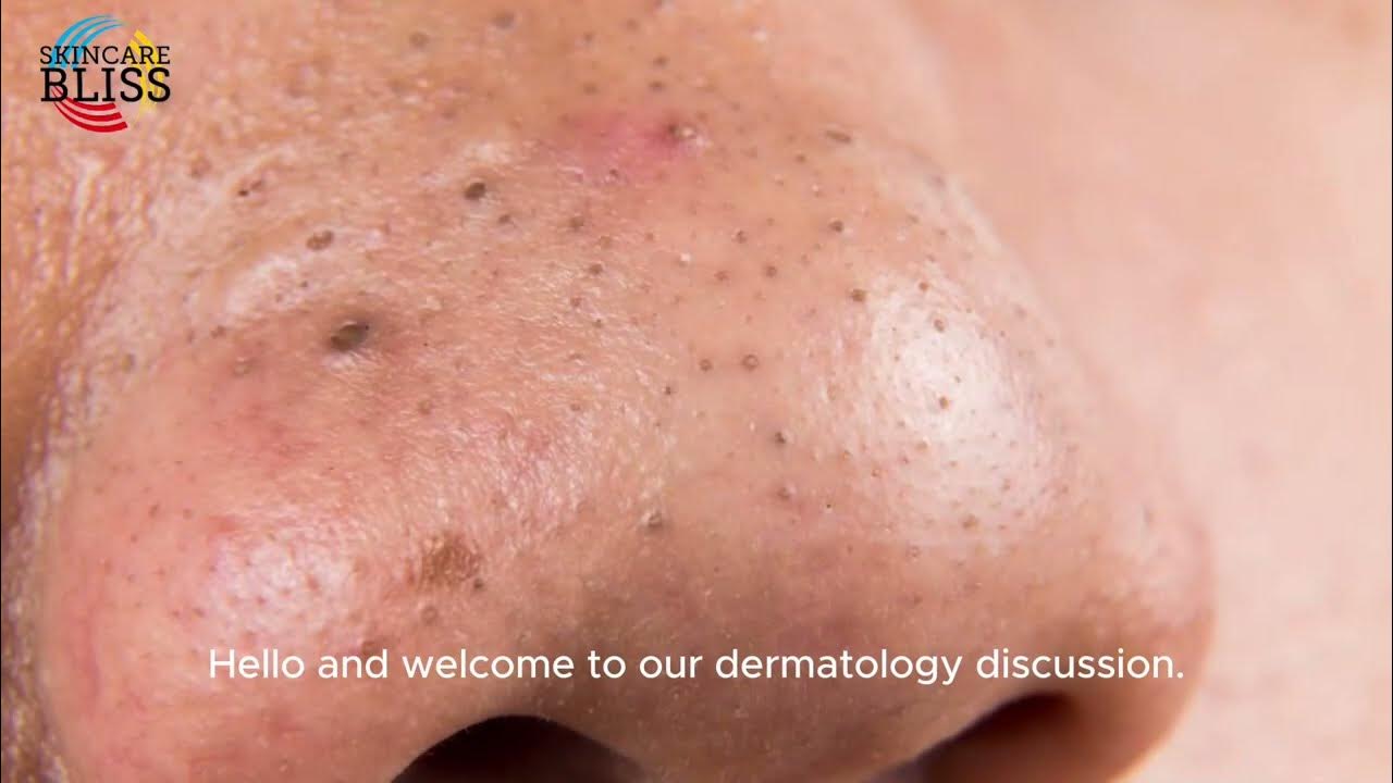can-dermatologist-remove-blackheads-youtube