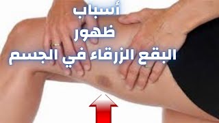 سبب ظهور بقع زرقاء علي الجسم بدون التعرض لإصابة|البقع الزرقاء|دكتور احمد حسن جمعه