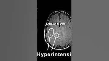 What Are These Dots? #shorts #mri #brain #movementdisorder #walking #aging #health #uctv #science