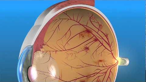 Proliferative Diabetic Retinopathy PDR