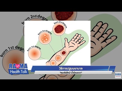 พบหมอรามาฯ : วิธีการปฐมพยาบาลแผลไฟไหม้-น้ำร้อนลวก :  Rama Health Talk (ช่วงที่ 1)  11.10.2562