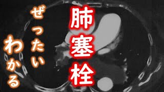 看護師国家試験　循環器　肺血栓塞栓症　肺塞栓　エコノミークラス症候群　血栓　深部静脈血栓　 心臓専門医　米山喜平