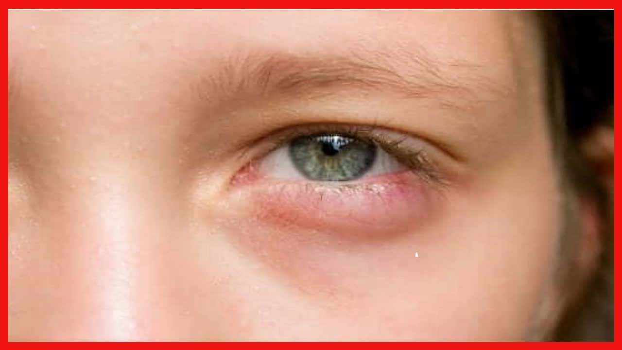 Acorda com os olhos inchados? 5 remédios rápidos! - YouTube