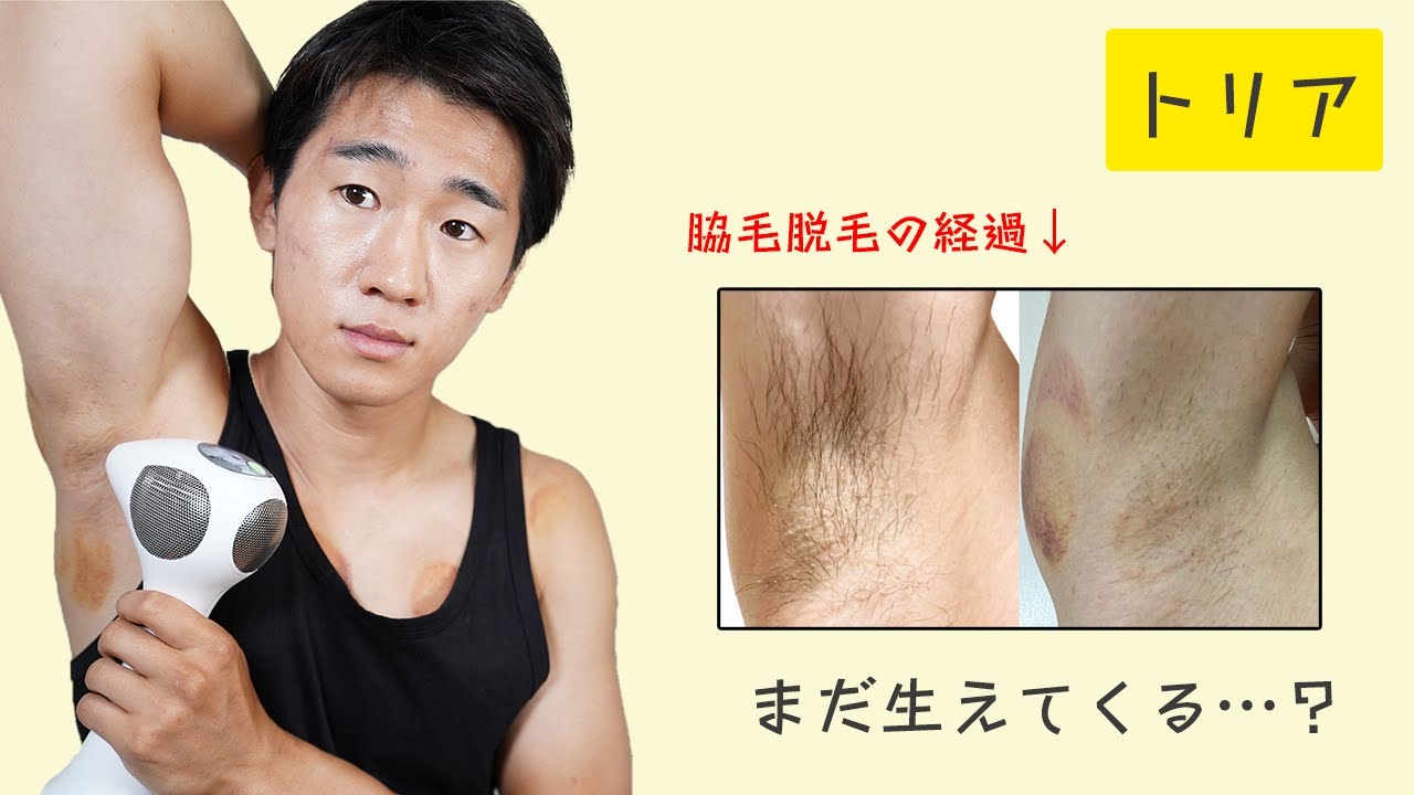 トリアで脇毛脱毛してみた経過がヤバかった・・・。ワキ毛の脱毛なら