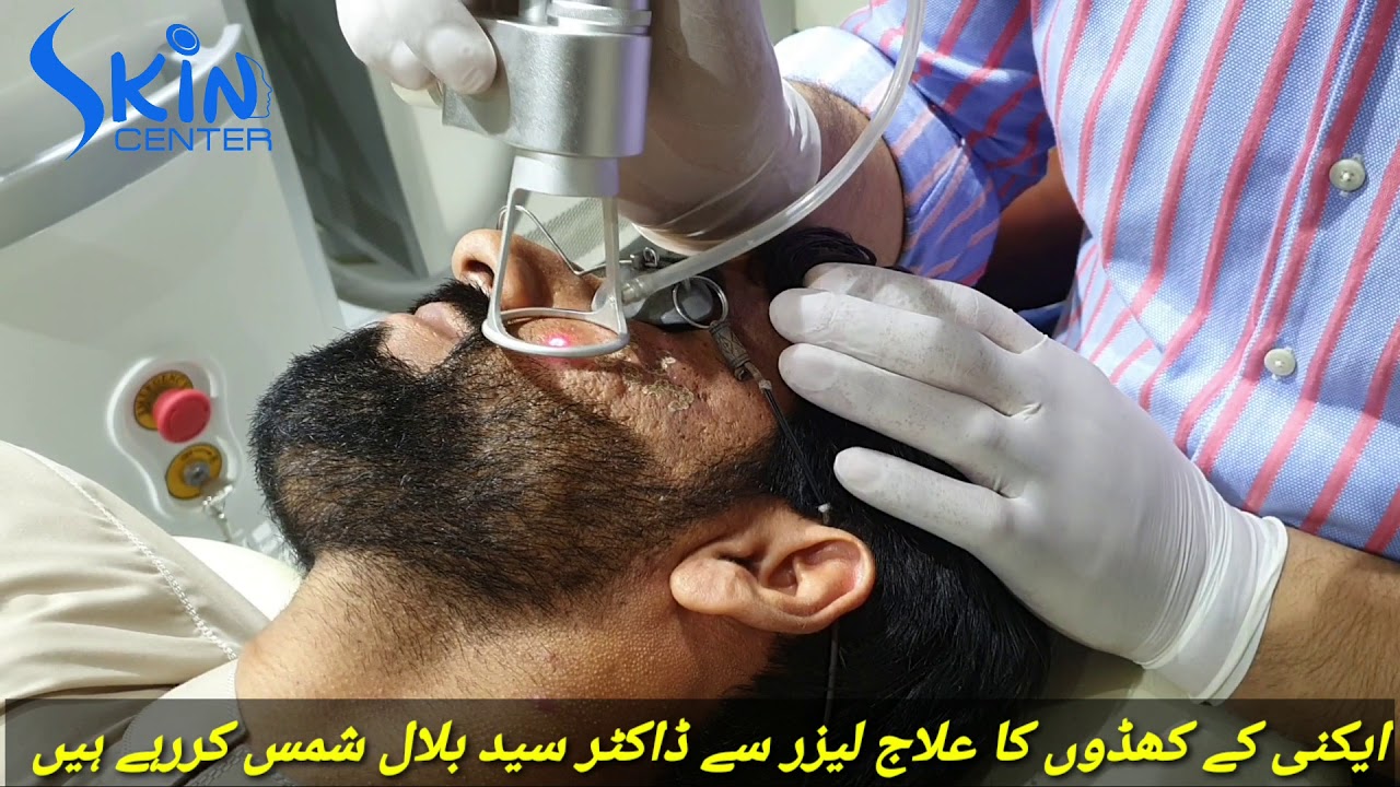 Acne scars treatment with CO2 Fractional laser by Dr Syed Bilal Shams