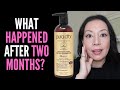 HAIR LOSS SUFFERER TESTS PURA D'OR PROFESSIONAL BIOTIN SHAMPOO 8 WEEK REVIEW WITH BEFORE AND AFTER