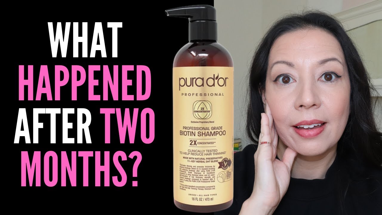HAIR LOSS SUFFERER TESTS PURA D'OR PROFESSIONAL BIOTIN SHAMPOO 8 WEEK  REVIEW WITH BEFORE AND AFTER 
