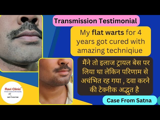 Followup after 1 years no recurrence of trouble 9 July 2024 Verruca Plana