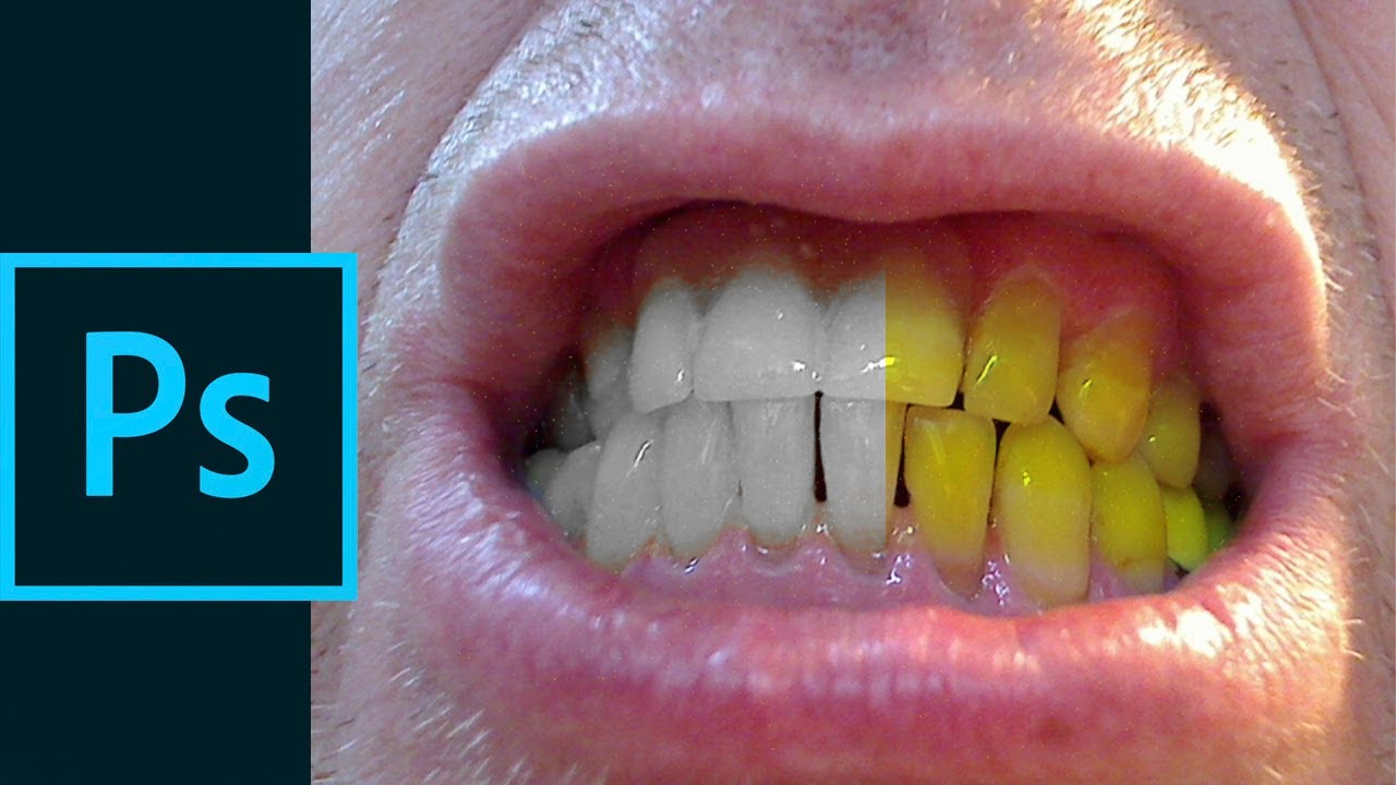 Se pueden blanquear los dientes amarillos