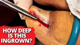 Permanent Removal Of Ingrown Nail After Sports Injury!