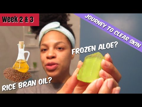 Are FLAXSEEDS Causing My Cystic Break Outs? // Trying Frozen Aloe To Heal My Acne Vlog