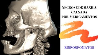 Necrose óssea da maxila causada por medicação - aviso: imagens fortes de cirurgia