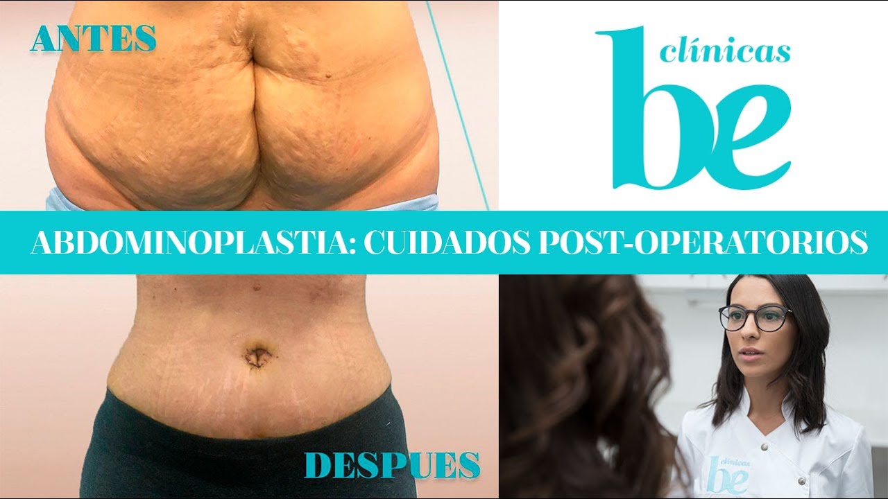 Abdominoplastia o cirugía de abdomen: cuidados post-operatorios