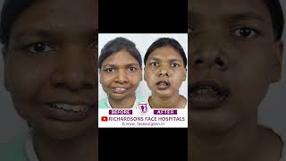 Face Make Over Surgery | Before &amp; After