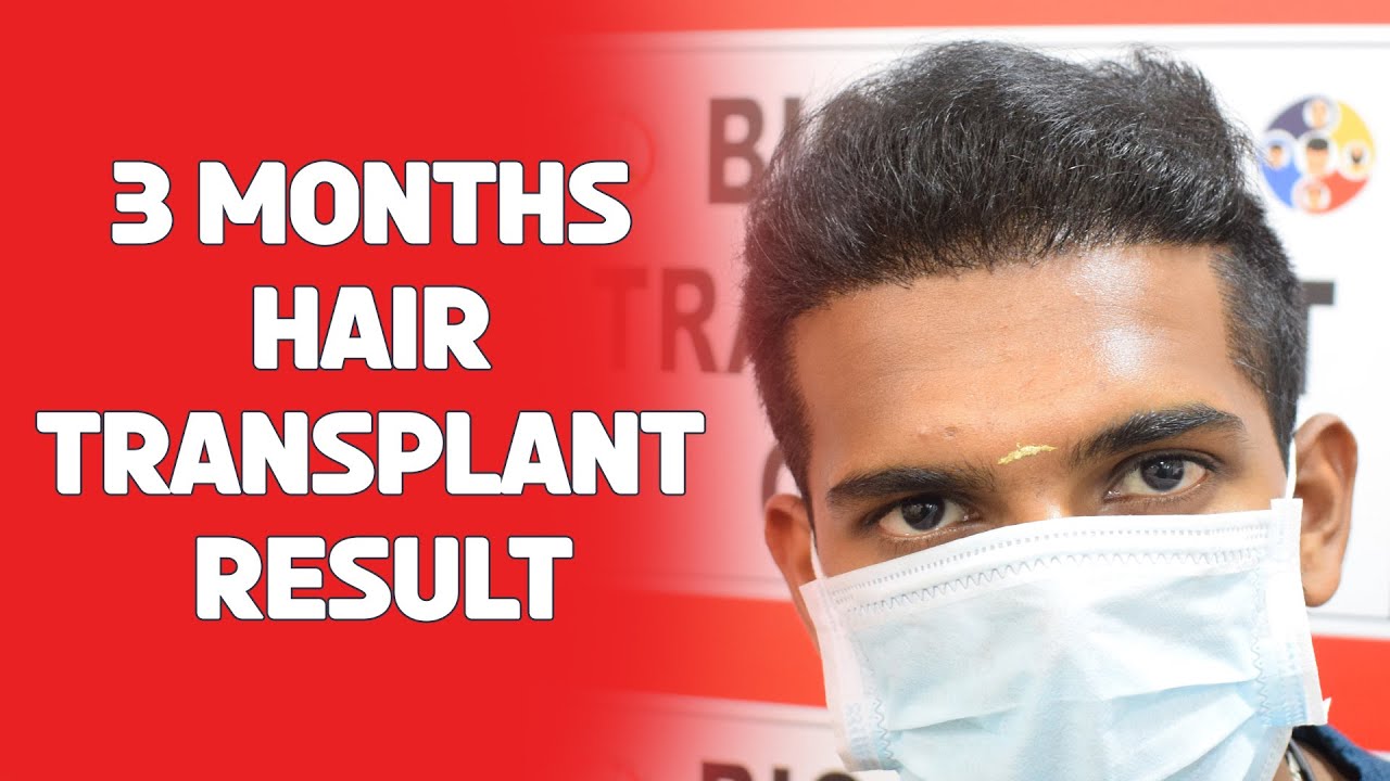 3 months hair Transplant Result | Bio Hair transplant clinic - YouTube