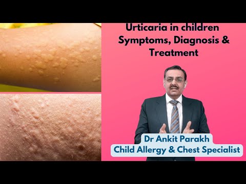 Video: Hoe Lyk Urticaria By Kinders?