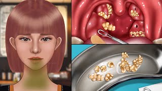 ASMR Smelly Old Tonsil Stone Removal Animation‼️,The cause of Bad Breath, White plaque removal