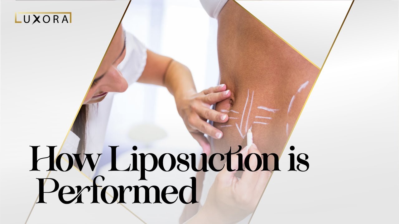 How Liposuction is Performed | A Step-by-Step explanation | Luxora ...