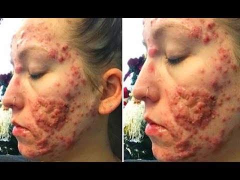 Stephanie&#;s Cystic Acne Treatment - How to Beat Acne!