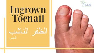 الظفر الناشب (المنغرز)   ingrown toenail (subtitled)