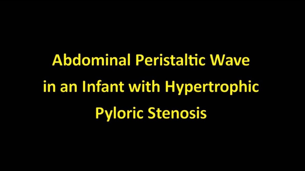 Peristaltic Waves in Hypertrophic Pyloric Stenosis YouTube