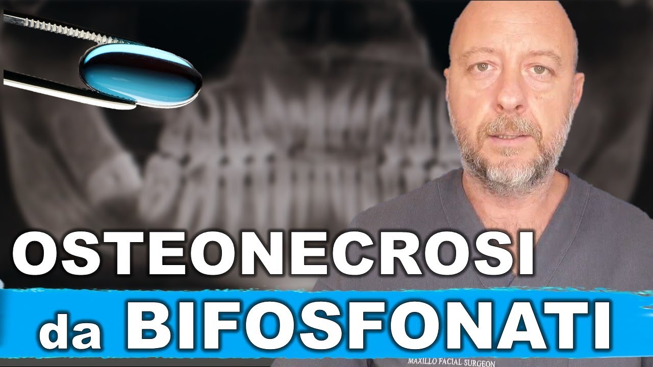 Osteonecrosi da bifosfonati: tra gli effetti collaterali vi è la necrosi ossea