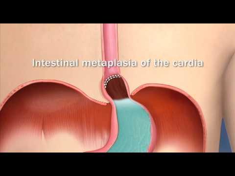 Video: Vad är gastric cardia?